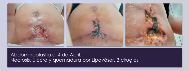 1. tratamiento_ulcera_quemadura_lipovaser_bomba_diamagnetica1