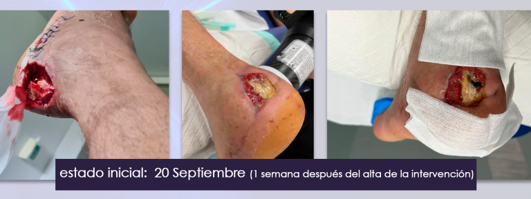 1.tratamiento_ulcera_calcaneo_bomba_diamagnetica_1