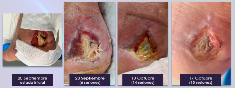 2.tratamiento_ulcera_calcaneo_bomba_diamagnetica_2