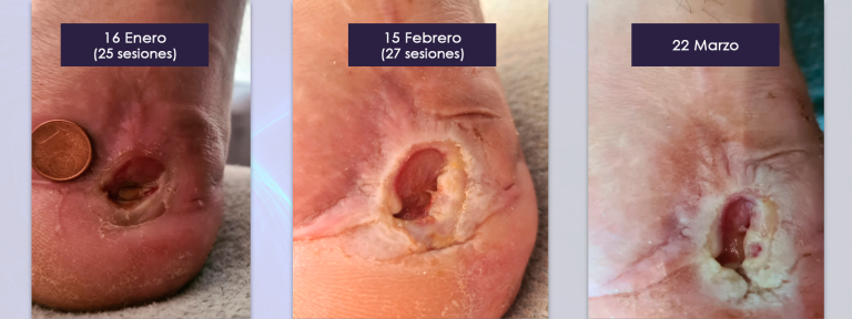 3.tratamiento_ulcera_calcaneo_bomba_diamagnetica_3