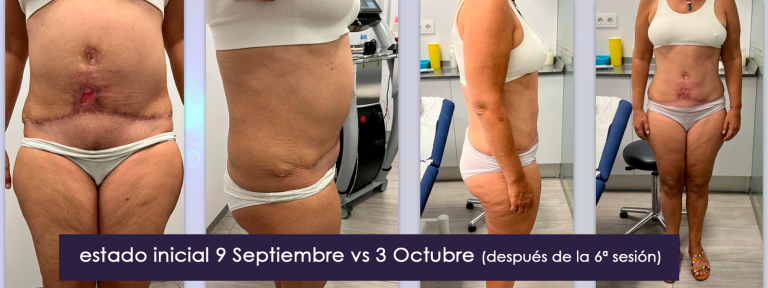 4. tratamiento_ulcera_quemadura_lipovaser_bomba_diamagnetica4