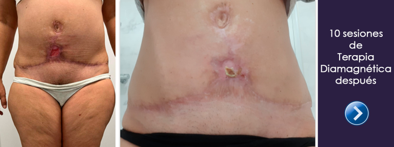 5. tratamiento_ulcera_quemadura_lipovaser_bomba_diamagnetica5