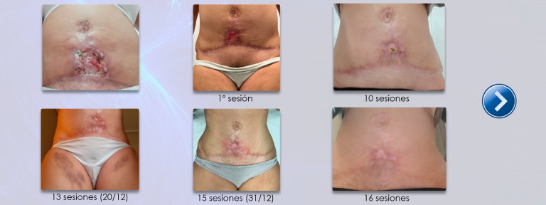 6.tratamiento_ulcera_quemadura_lipovaser_bomba_diamagnetica7